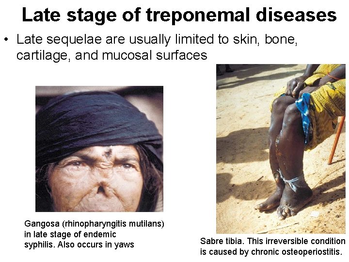 Late stage of treponemal diseases • Late sequelae are usually limited to skin, bone,