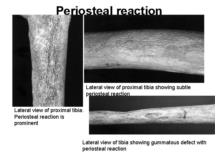 Periosteal reaction Lateral view of proximal tibia showing subtle periosteal reaction Lateral view of