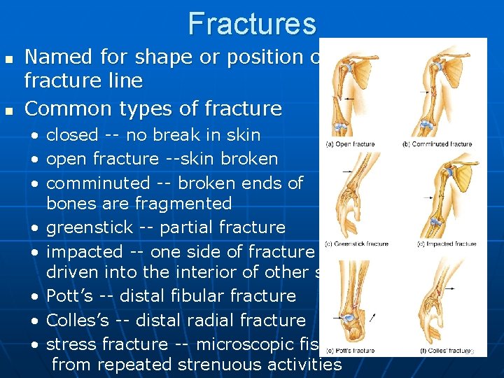 Fractures n n Named for shape or position of fracture line Common types of