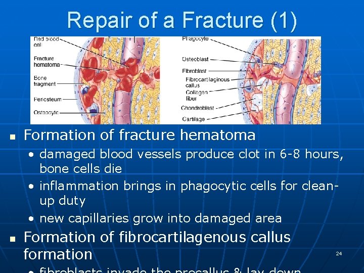 Repair of a Fracture (1) n Formation of fracture hematoma • damaged blood vessels