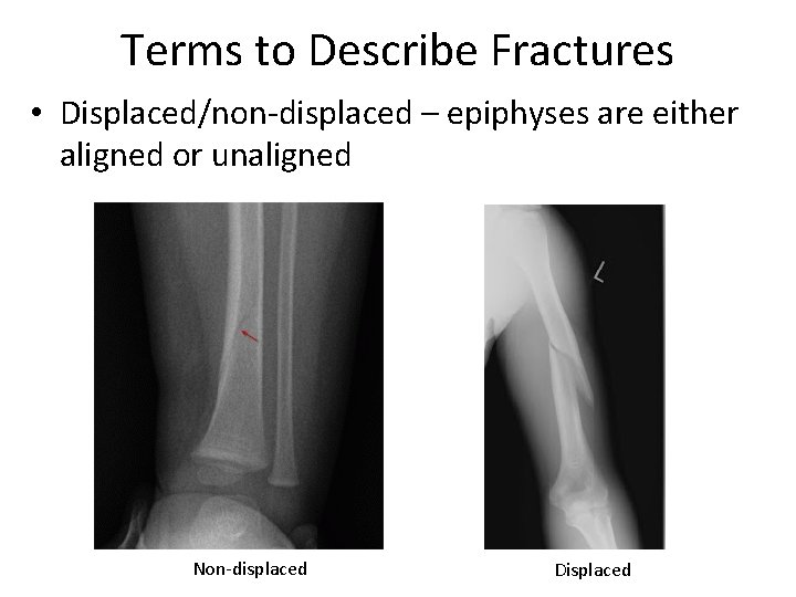 Terms to Describe Fractures • Displaced/non-displaced – epiphyses are either aligned or unaligned Non-displaced