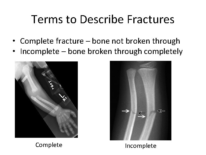 Terms to Describe Fractures • Complete fracture – bone not broken through • Incomplete