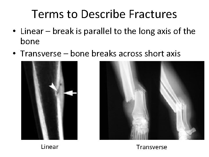 Terms to Describe Fractures • Linear – break is parallel to the long axis