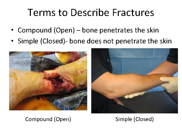 Terms to Describe Fractures • Compound (Open) – bone penetrates the skin • Simple