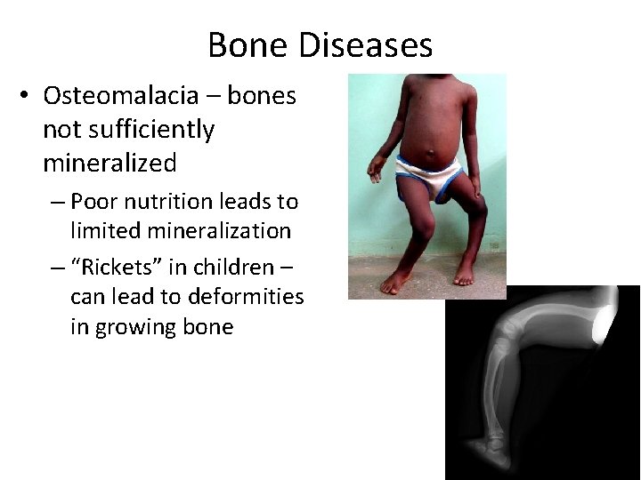 Bone Diseases • Osteomalacia – bones not sufficiently mineralized – Poor nutrition leads to