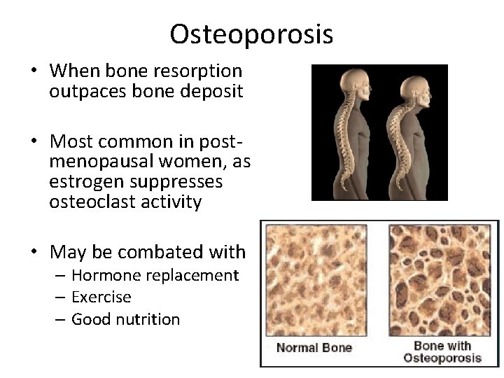 Osteoporosis • When bone resorption outpaces bone deposit • Most common in postmenopausal women,