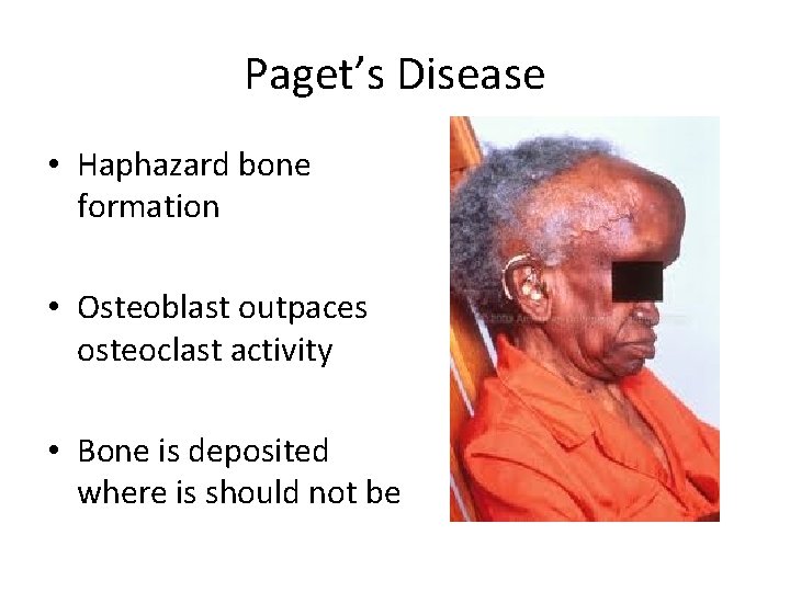 Paget’s Disease • Haphazard bone formation • Osteoblast outpaces osteoclast activity • Bone is