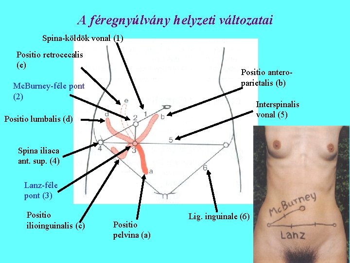 A féregnyúlvány helyzeti változatai Spina-köldök vonal (1) Positio retrocecalis (e) Positio anteroparietalis (b) Mc.