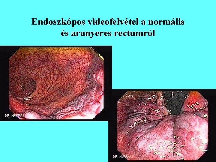 Endoszkópos videofelvétel a normális és aranyeres rectumról 