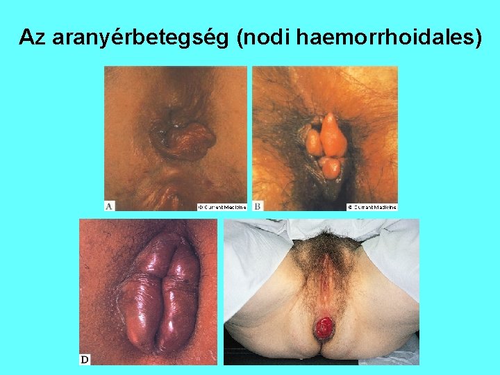 Az aranyérbetegség (nodi haemorrhoidales) 