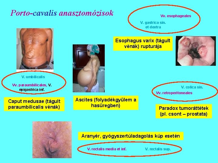 Porto-cavalis anasztomózisok Vv. esophageales V. gastrica sin. et dextra Esophagus varix (tágult vénák) rupturája