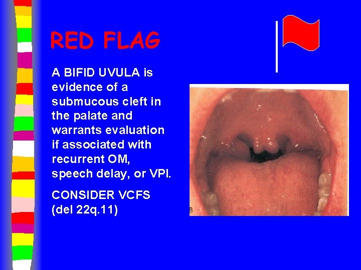 RED FLAG A BIFID UVULA is evidence of a submucous cleft in the palate