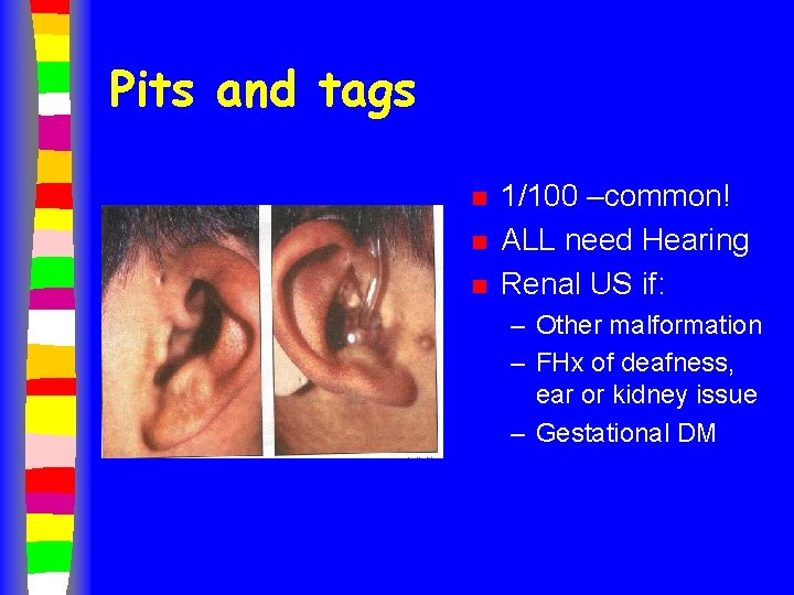 Pits and tags n n n 1/100 –common! ALL need Hearing Renal US if: