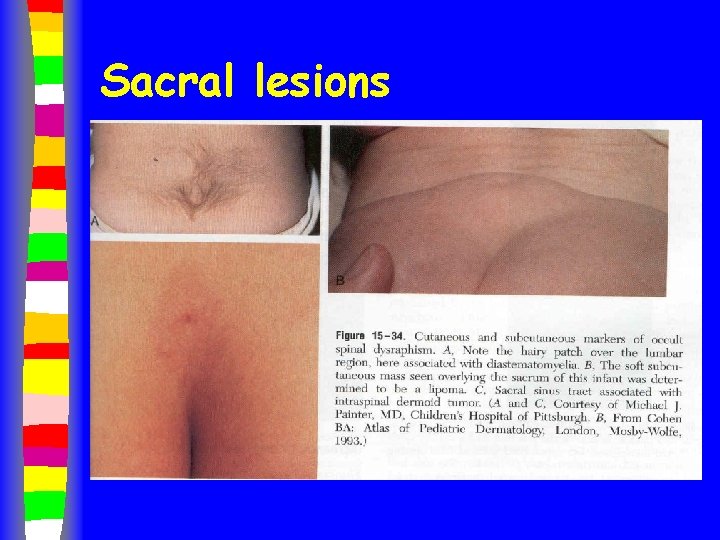 Sacral lesions 