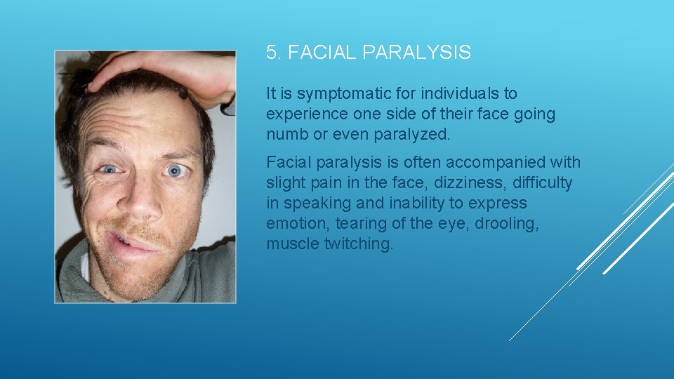 5. FACIAL PARALYSIS It is symptomatic for individuals to experience one side of their