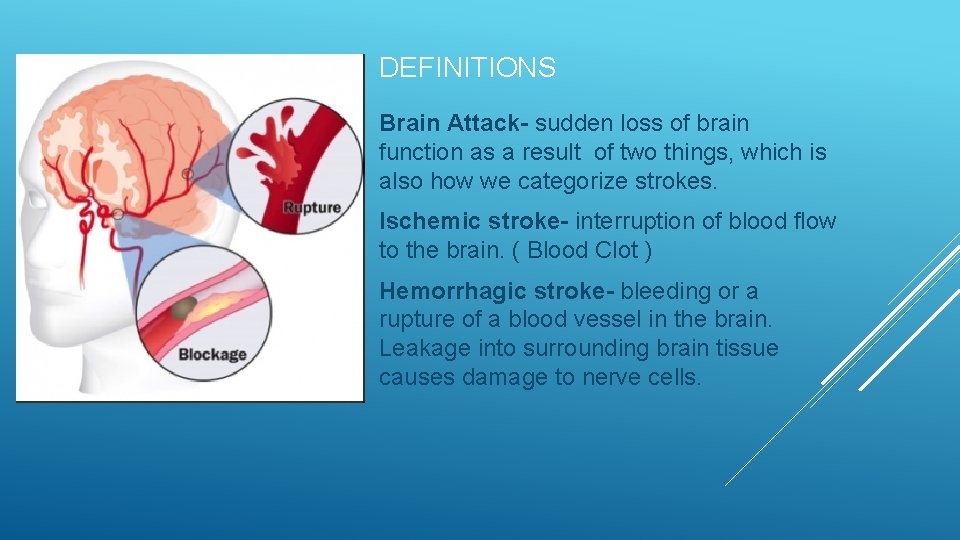 DEFINITIONS Brain Attack- sudden loss of brain function as a result of two things,