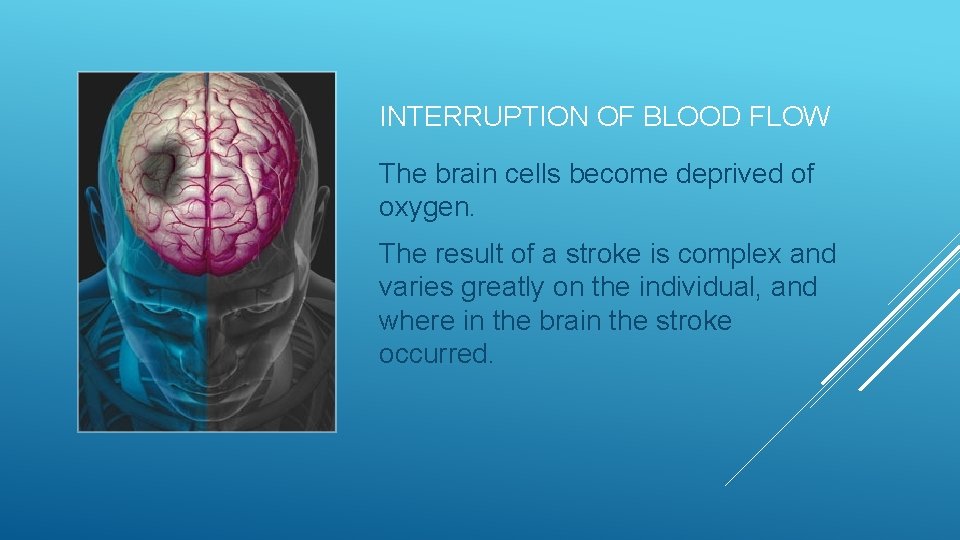 INTERRUPTION OF BLOOD FLOW The brain cells become deprived of oxygen. The result of