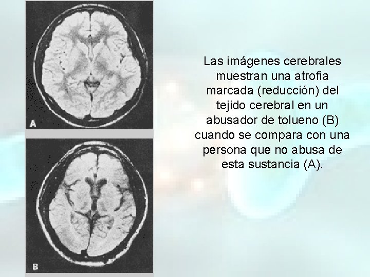 Las imágenes cerebrales muestran una atrofia marcada (reducción) del tejido cerebral en un abusador