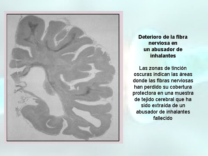 Deterioro de la fibra nerviosa en un abusador de inhalantes Las zonas de tinción