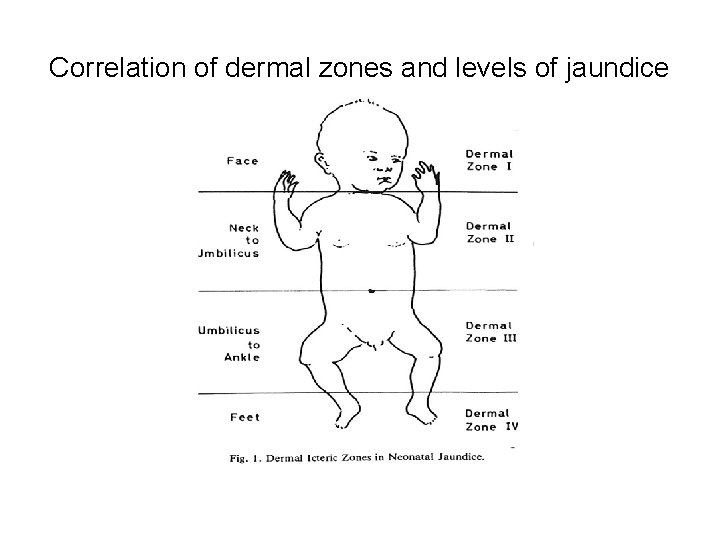 Correlation of dermal zones and levels of jaundice 