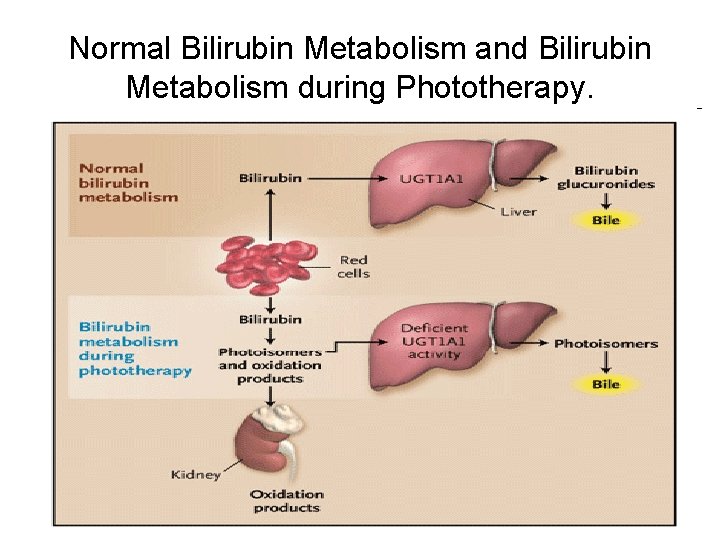 Normal Bilirubin Metabolism and Bilirubin Metabolism during Phototherapy. 