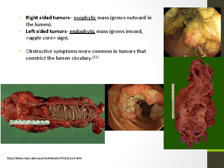  • Right sided tumors– exophytic mass (grows outward in the lumen). • Left