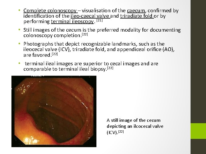  • Complete colonoscopy – visualisation of the caecum, confirmed by identification of the