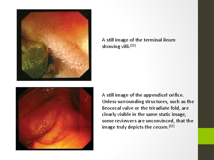 A still image of the terminal ileum showing villi. [22] A still image of