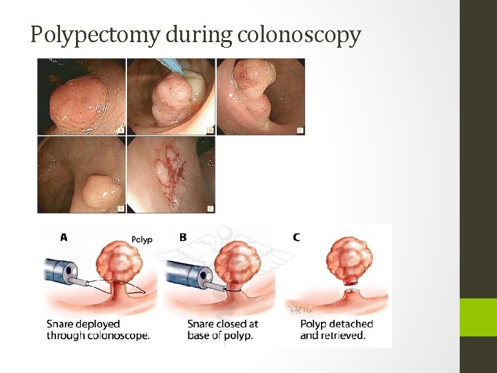 Polypectomy during colonoscopy 
