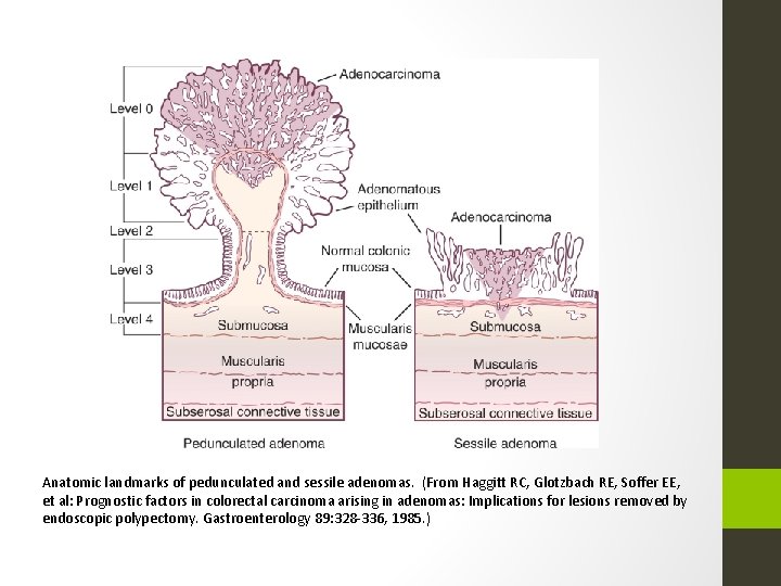 Anatomic landmarks of pedunculated and sessile adenomas. (From Haggitt RC, Glotzbach RE, Soffer EE,