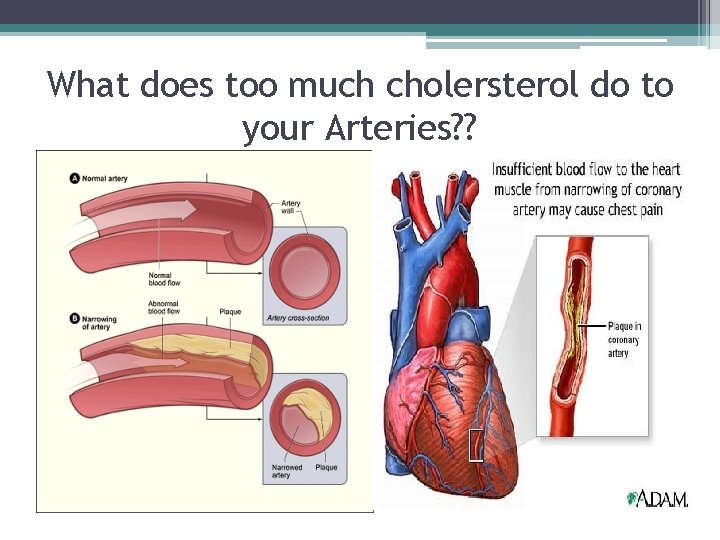 What does too much cholersterol do to your Arteries? ? 