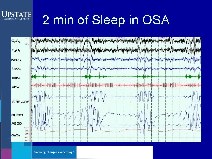 2 min of Sleep in OSA 