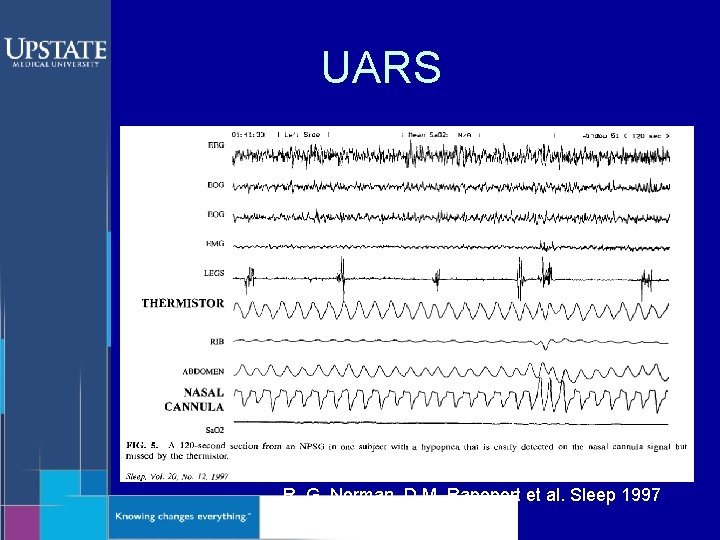 UARS R. G. Norman, D M. Rapoport et al. Sleep 1997 