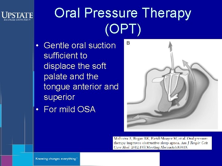 Oral Pressure Therapy (OPT) • Gentle oral suction sufficient to displace the soft palate