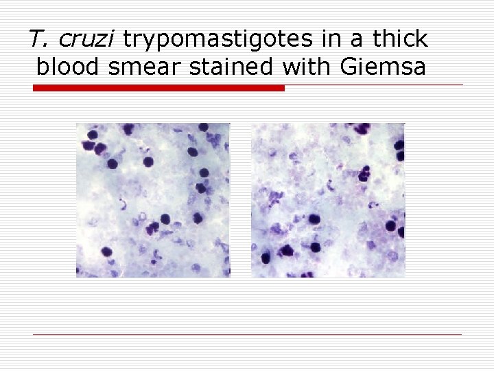 T. cruzi trypomastigotes in a thick blood smear stained with Giemsa 