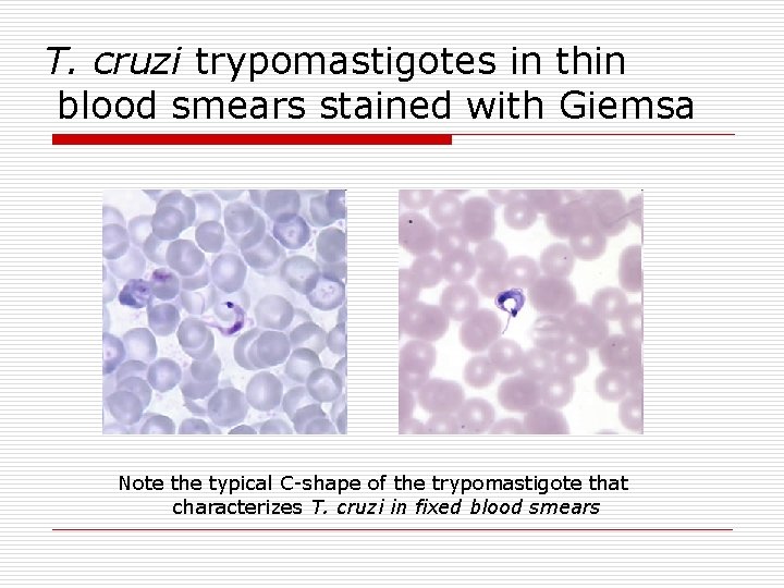 T. cruzi trypomastigotes in thin blood smears stained with Giemsa Note the typical C-shape