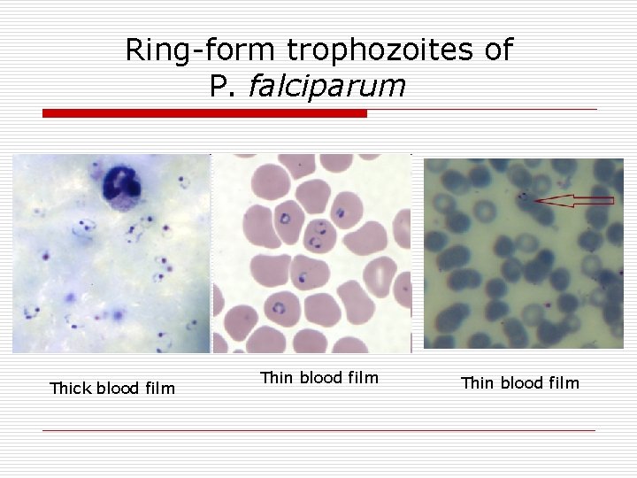 Ring-form trophozoites of P. falciparum Thick blood film Thin blood film 