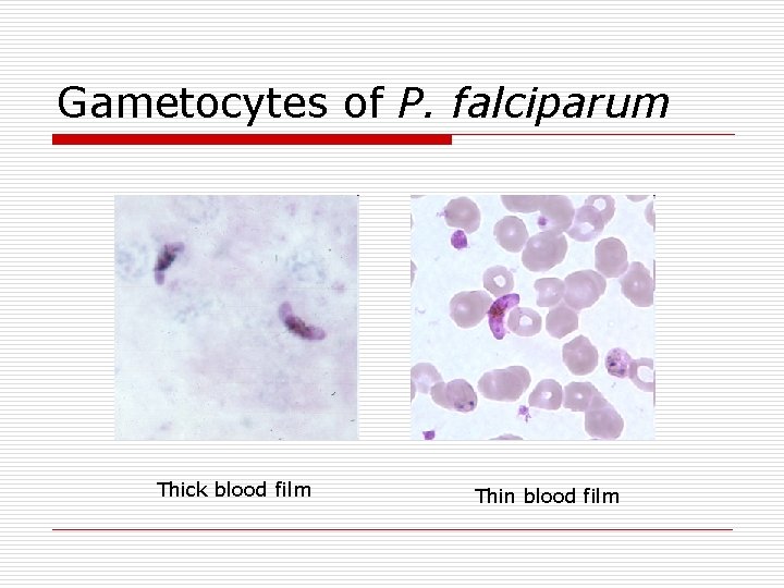 Gametocytes of P. falciparum Thick blood film Thin blood film 