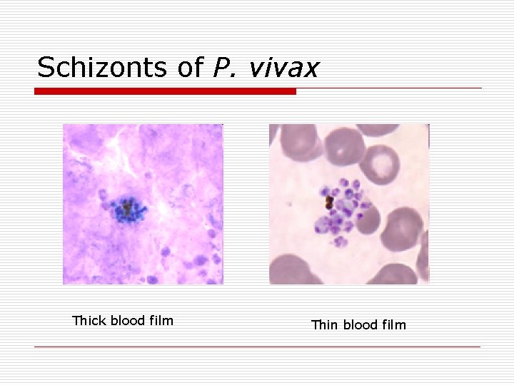 Schizonts of P. vivax Thick blood film Thin blood film 