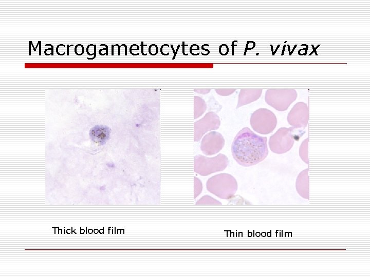 Macrogametocytes of P. vivax Thick blood film Thin blood film 