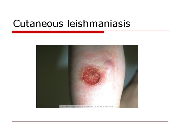 Cutaneous leishmaniasis 