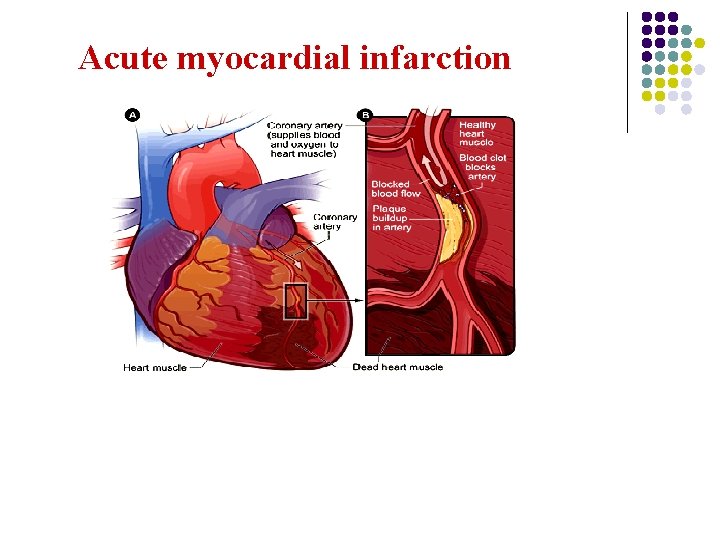 Acute myocardial infarction 