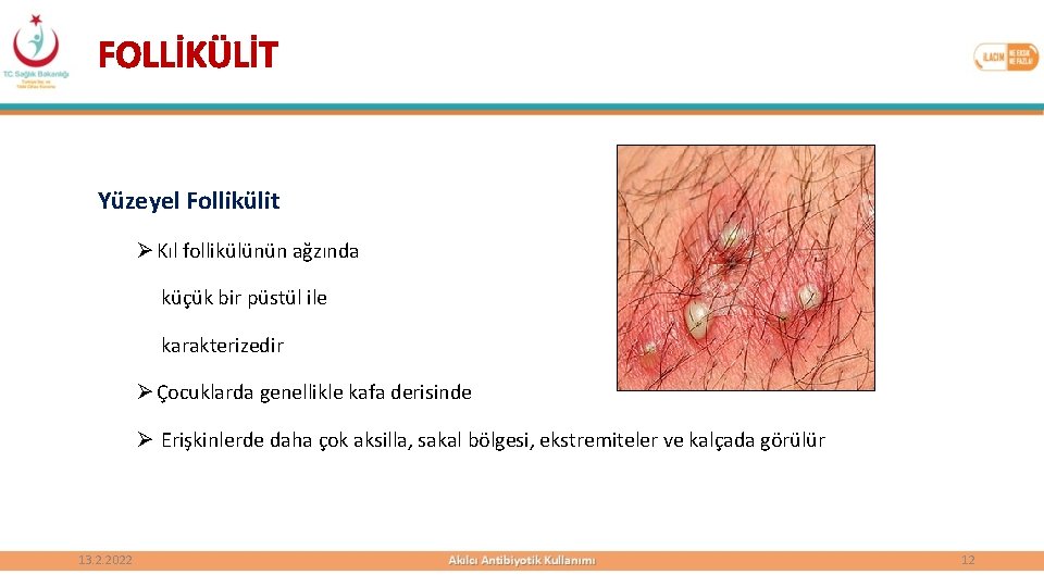 FOLLİKÜLİT Yüzeyel Follikülit Ø Kıl follikülünün ağzında küçük bir püstül ile karakterizedir Ø Çocuklarda