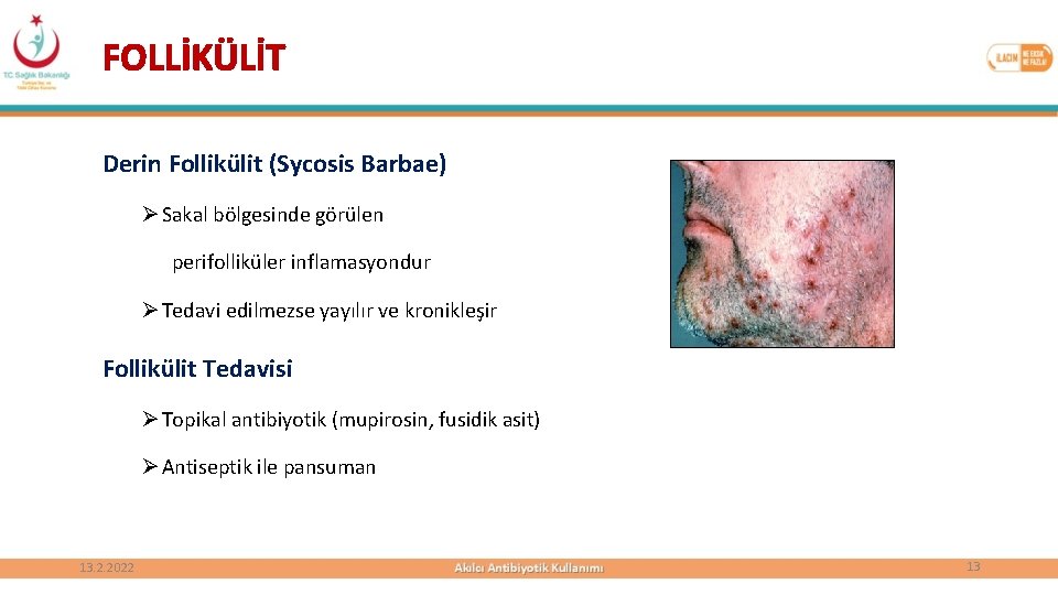 FOLLİKÜLİT Derin Follikülit (Sycosis Barbae) Ø Sakal bölgesinde görülen perifolliküler inflamasyondur Ø Tedavi edilmezse