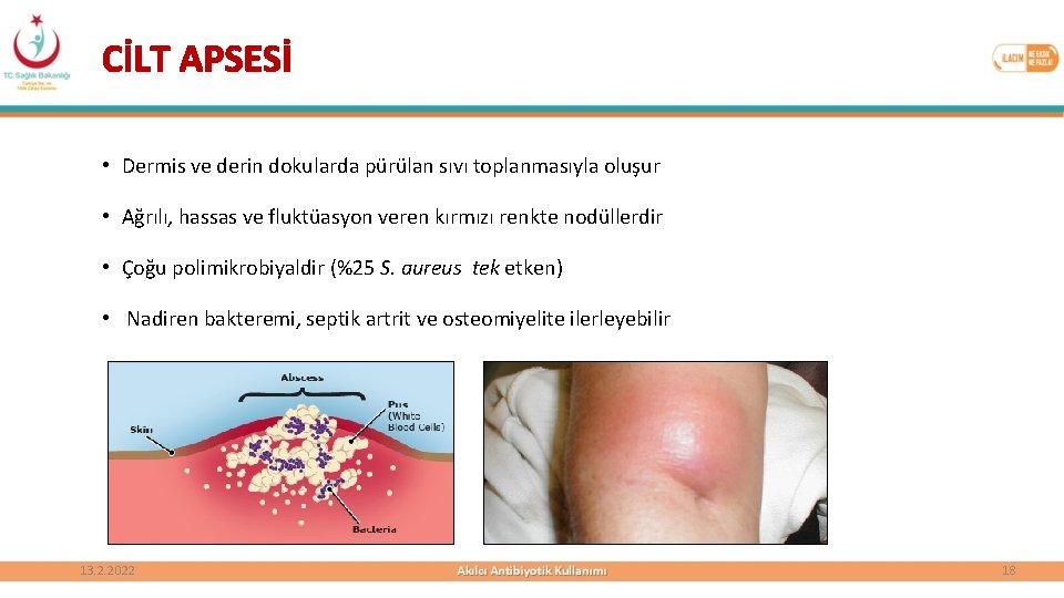 CİLT APSESİ • Dermis ve derin dokularda pürülan sıvı toplanmasıyla oluşur • Ağrılı, hassas