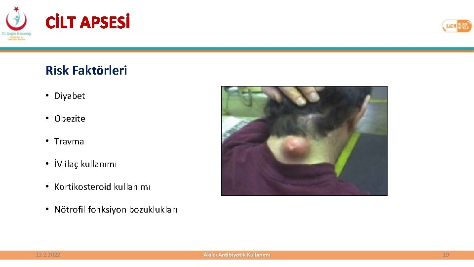 CİLT APSESİ Risk Faktörleri • Diyabet • Obezite • Travma • İV ilaç kullanımı