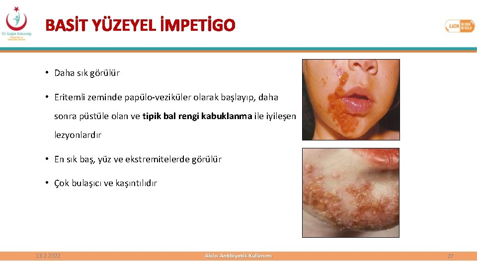 BASİT YÜZEYEL İMPETİGO • Daha sık görülür • Eritemli zeminde papülo-veziküler olarak başlayıp, daha