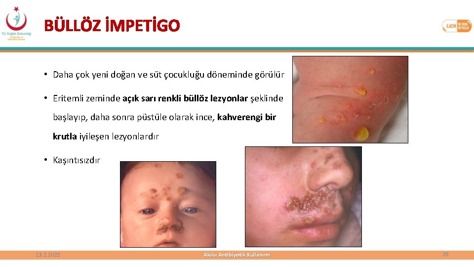 BÜLLÖZ İMPETİGO • Daha çok yeni doğan ve süt çocukluğu döneminde görülür • Eritemli