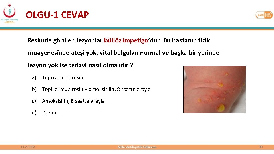 OLGU-1 CEVAP Resimde görülen lezyonlar büllöz impetigo’dur. Bu hastanın fizik muayenesinde ateşi yok, vital