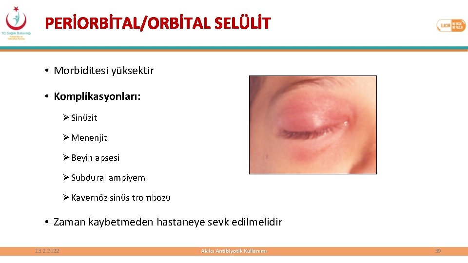 PERİORBİTAL/ORBİTAL SELÜLİT • Morbiditesi yüksektir • Komplikasyonları: Ø Sinüzit Ø Menenjit Ø Beyin apsesi
